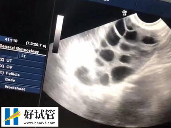 试管婴儿第一次检查要查什么?女性心电图、乙肝5项不可少(图1) 试管婴儿前要注意什么