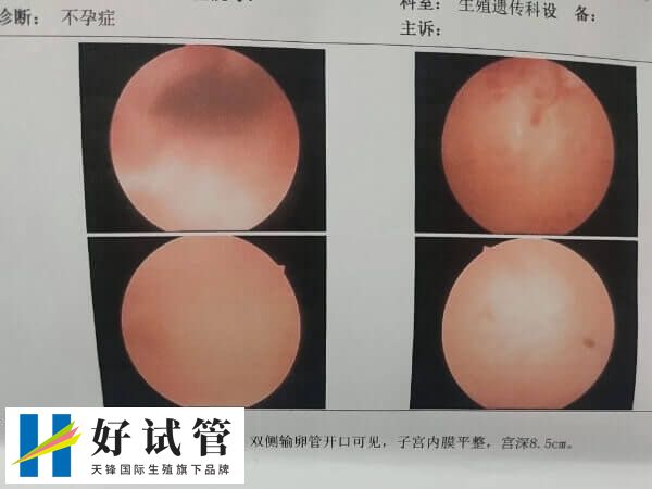 宫腔粘连需要手术治疗